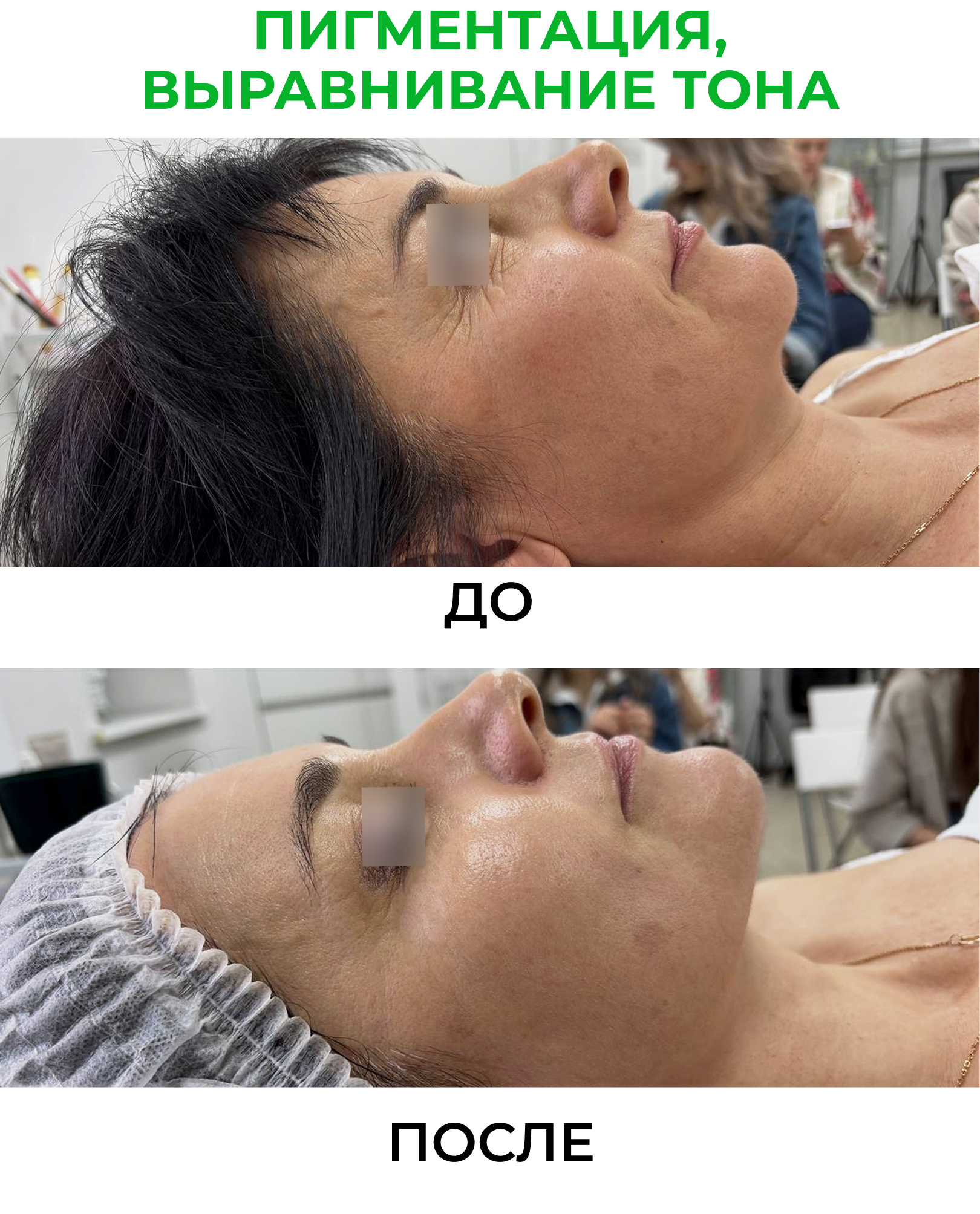 Ultra-MPeel